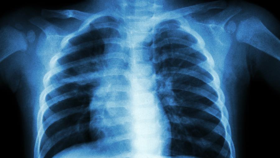 Tuberculose à l'école : une vingtaine de cas par an